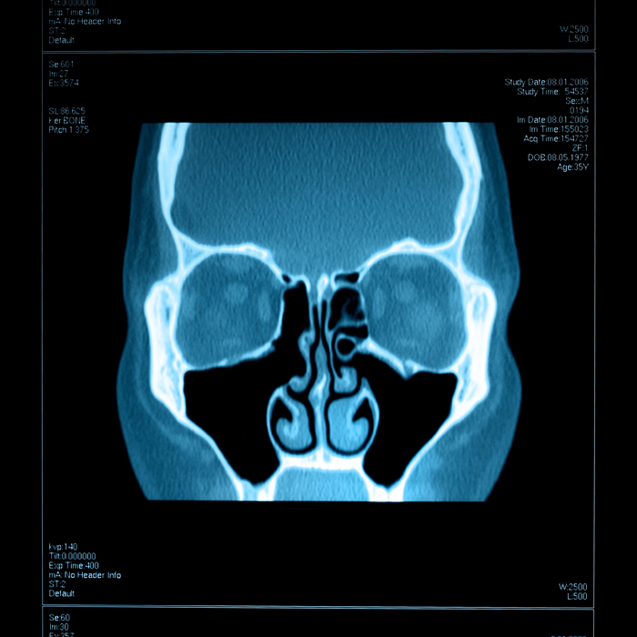 Nose and Sinus